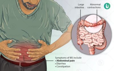 L’integrazione con propoli è utile in caso della sindrome da colon irritabile